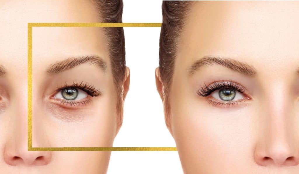 blefaroplastia 